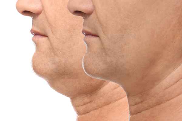 HIFU - Breakthrough in Anti - ageing 2 hifu results Weymouth