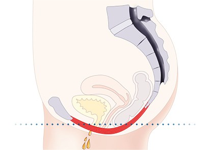 Pelvic-Floor Muscle Repair 5 Pelvic floor muscles Weymouth