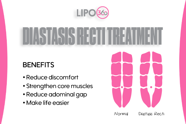 Revolutionising Muscle Repair: The Power of LIPO360 Body Sculpt Post-Injury 5 diastasis recti treatment Weymouth