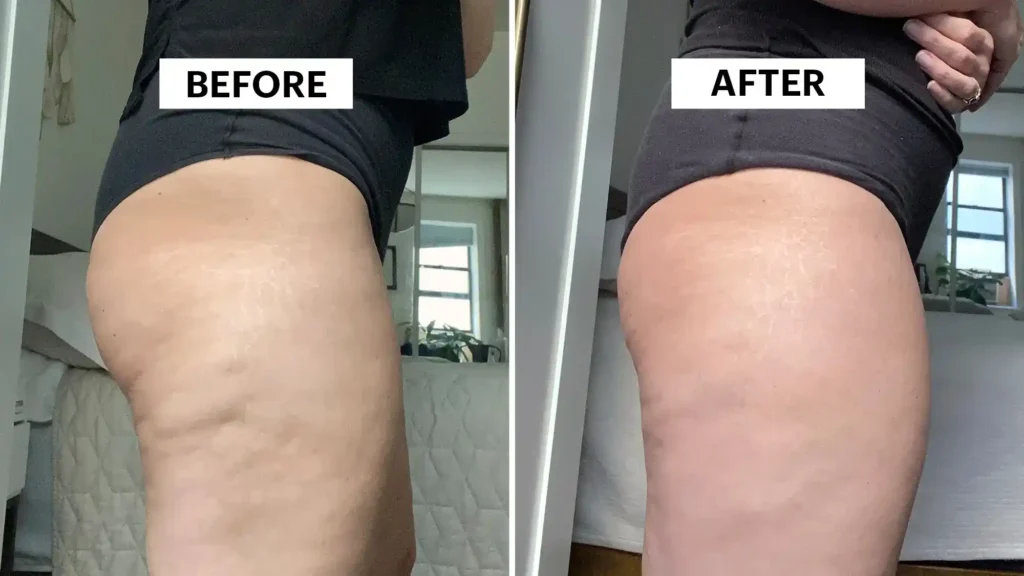 Sculpting Your Bum: Can Toning Exercises Really Reduce Cellulite? 1 Do Toning Exercise Weymouth Really Tackle Cellulite?
