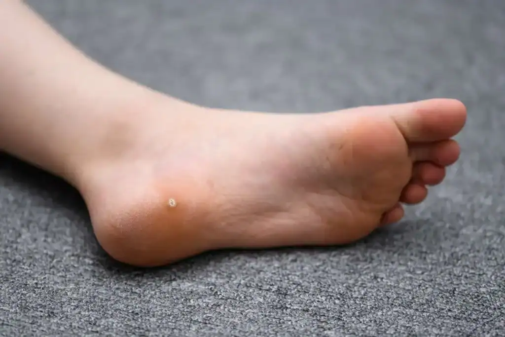 Cryotherapy For Warts And Also Verrucas 2 Image of verruca on the bottom of the foot that able to be treated with Cryotherapy Weymouth