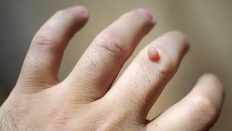 Image of blemish that Cryotherapy Weymouth can remove with Lipo 360.