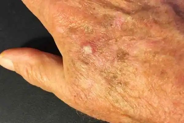Cryopen For Actinic Keratoses 1 Image of Actinic keratoses Weymouth on a person hand