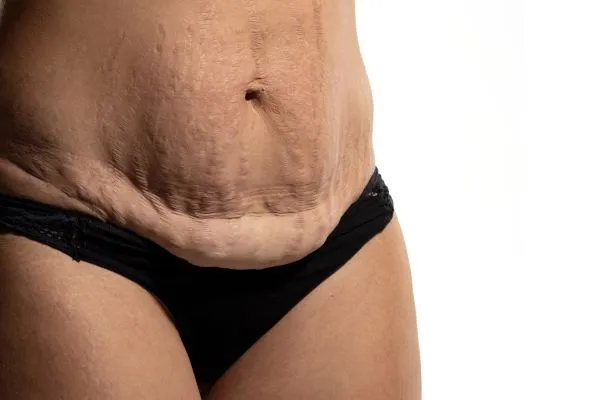 The science behind skin tightening Weymouth picture of a woman's sagging skin on the stomach